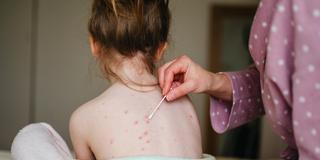 Auf dem Rücken eines Kindes ist der Ausschlag von Windpocken zu sehen. Die Mutter trägt ein Gel auf. (Foto: picture alliance / Westend61 | Inga Erhan)