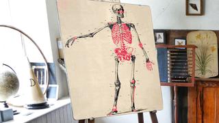 Skelett mit den bisherigen Knochenbrüchen  (Foto: Montage aus unsplashCyyAj0QboY/imago0099459202h)